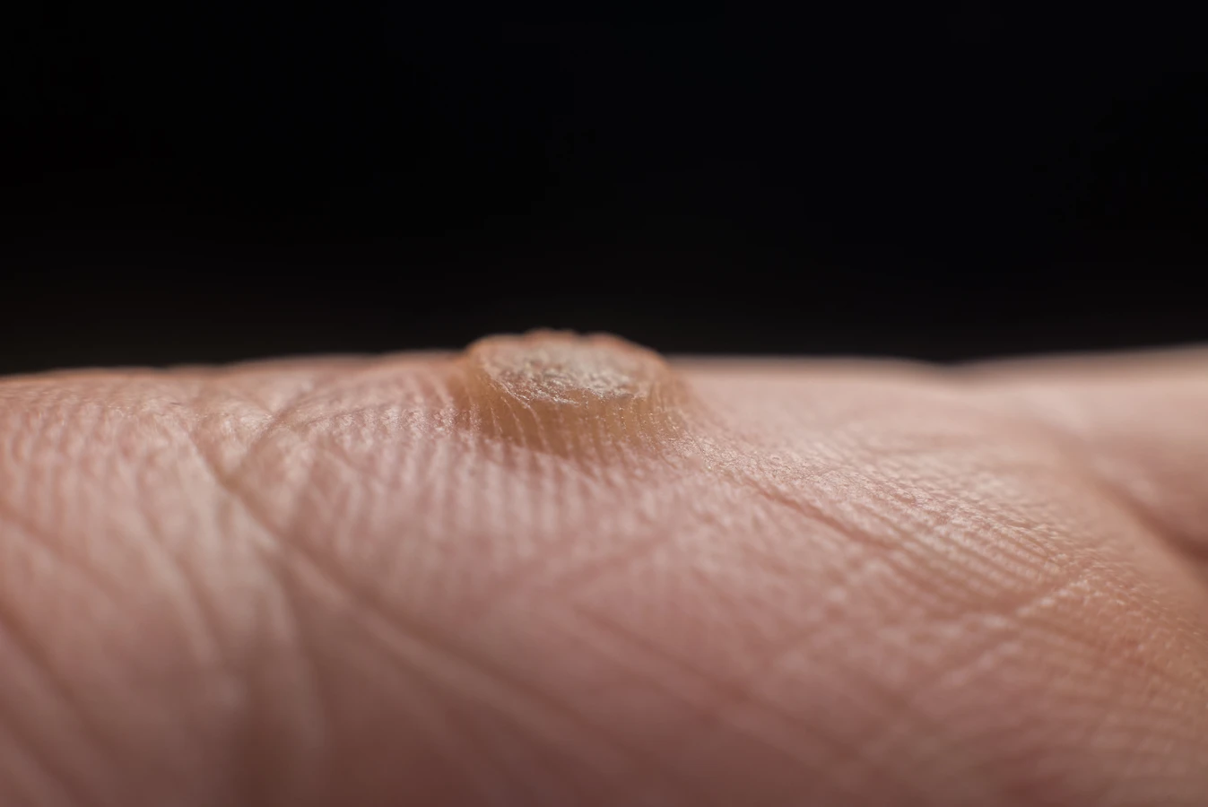 Co powoduje kurzajki?