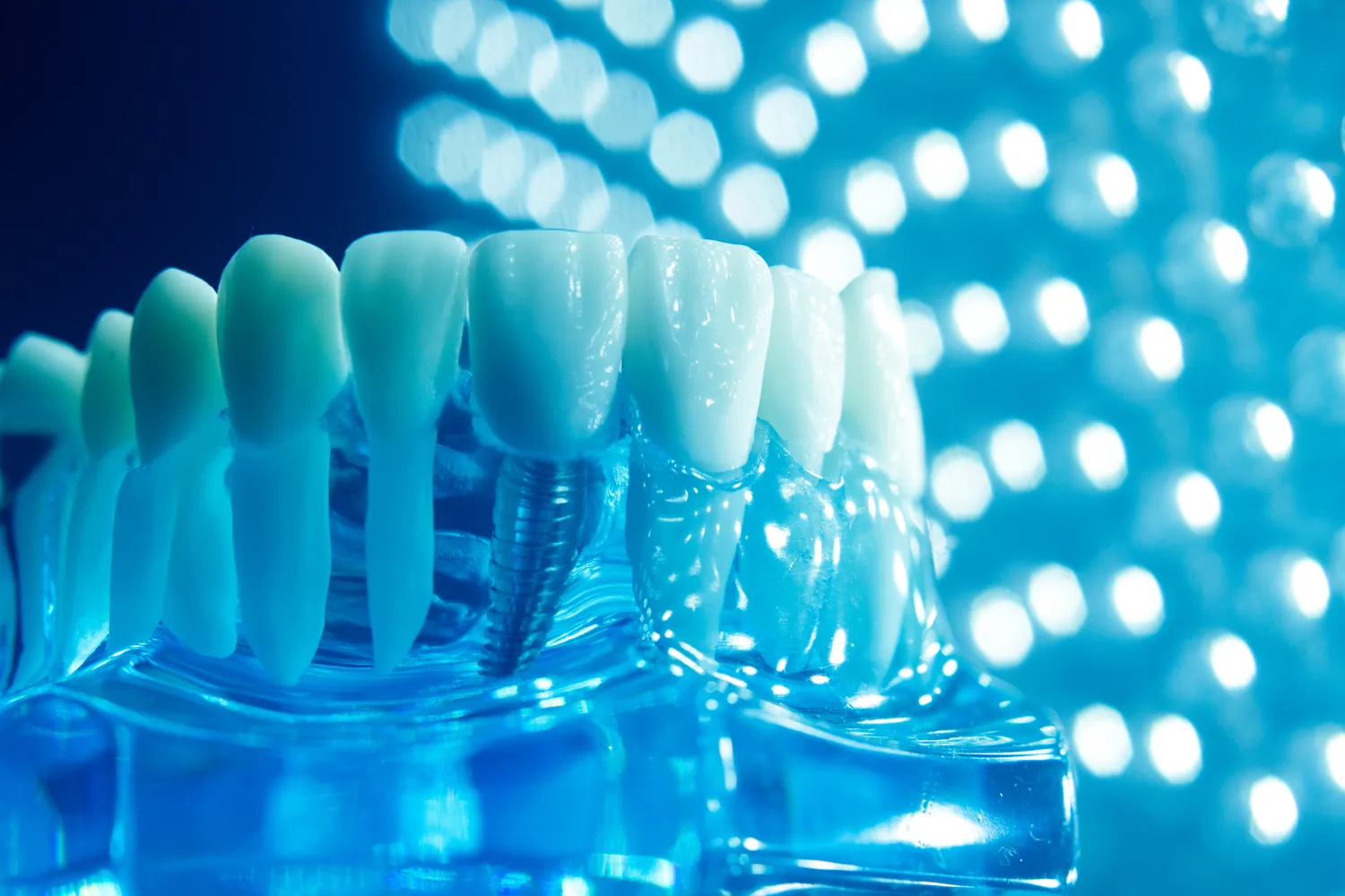 Implanty zębów cała szczęka cena Szczecin