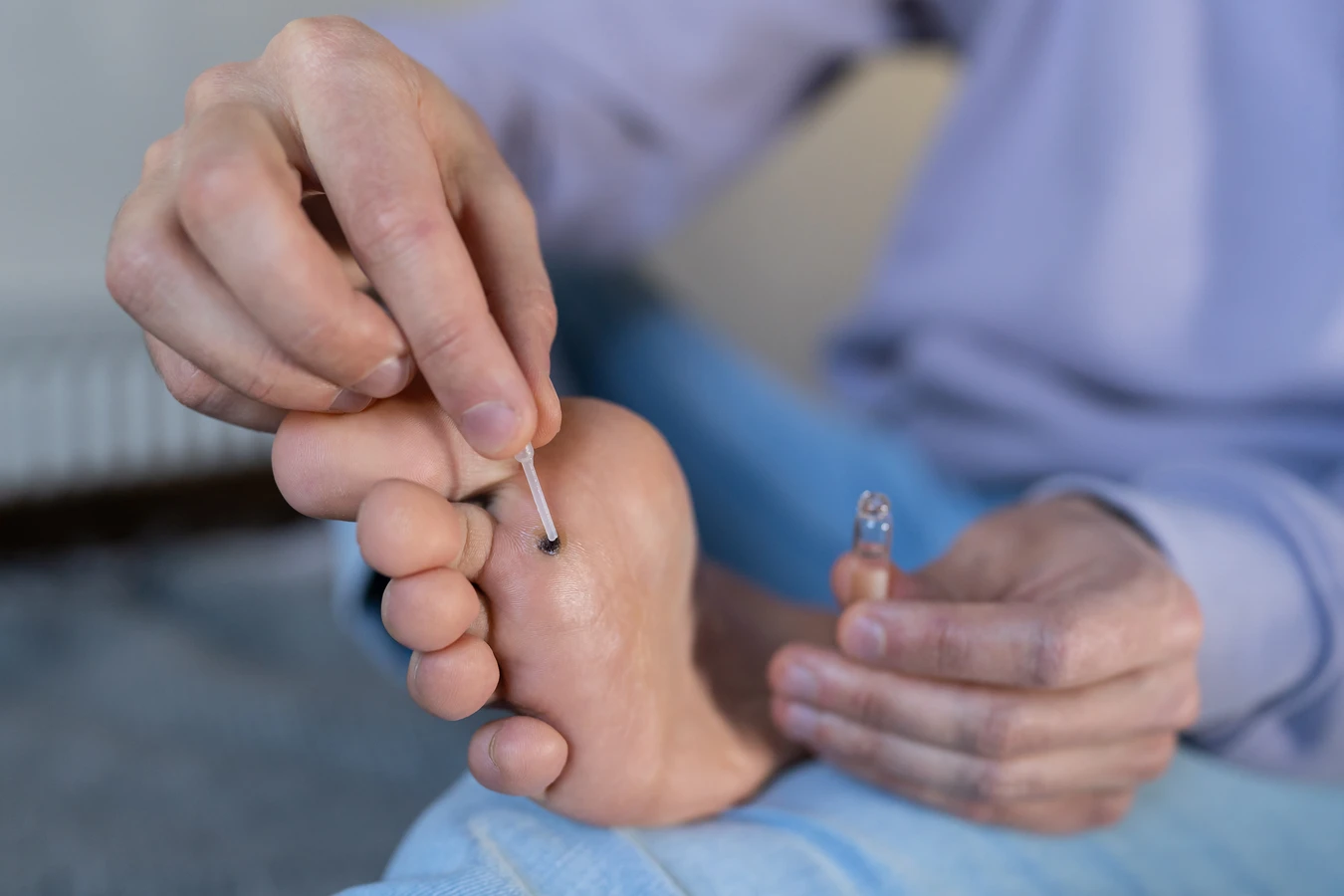Kurzajki podolog czy dermatolog?
